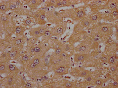 IHC image of CSB-PA836757OA01HU diluted at 1:200 and staining in paraffin-embedded human liver cancer performed on a Leica BondTM system. After dewaxing and hydration, antigen retrieval was mediated by high pressure in a citrate buffer (pH 6.0). Section was blocked with 10% normal goat serum 30min at RT. Then primary antibody (1% BSA) was incubated at 4°C overnight. The primary is detected by a Goat anti-rabbit polymer IgG labeled by HRP and visualized using 0.05% DAB.