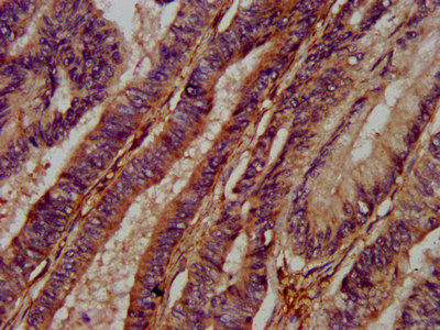 IHC image of CSB-PA837445LA01HU diluted at 1:400 and staining in paraffin-embedded human colon cancer performed on a Leica BondTM system. After dewaxing and hydration, antigen retrieval was mediated by high pressure in a citrate buffer (pH 6.0). Section was blocked with 10% normal goat serum 30min at RT. Then primary antibody (1% BSA) was incubated at 4&deg;C overnight. The primary is detected by a biotinylated secondary antibody and visualized using an HRP conjugated SP system.