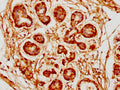IHC image of CSB-PA839345LA01HU diluted at 1:300 and staining in paraffin-embedded human breast cancer performed on a Leica BondTM system. After dewaxing and hydration, antigen retrieval was mediated by high pressure in a citrate buffer (pH 6.0). Section was blocked with 10% normal goat serum 30min at RT. Then primary antibody (1% BSA) was incubated at 4°C overnight. The primary is detected by a biotinylated secondary antibody and visualized using an HRP conjugated SP system.