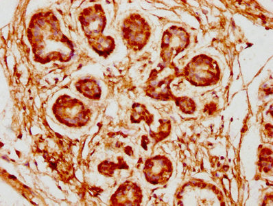 IHC image of CSB-PA839345LA01HU diluted at 1:300 and staining in paraffin-embedded human breast cancer performed on a Leica BondTM system. After dewaxing and hydration, antigen retrieval was mediated by high pressure in a citrate buffer (pH 6.0). Section was blocked with 10% normal goat serum 30min at RT. Then primary antibody (1% BSA) was incubated at 4°C overnight. The primary is detected by a biotinylated secondary antibody and visualized using an HRP conjugated SP system.