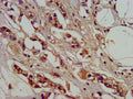 IHC image of CSB-PA839416LA01HU diluted at 1:400 and staining in paraffin-embedded human breast cancer performed on a Leica BondTM system. After dewaxing and hydration, antigen retrieval was mediated by high pressure in a citrate buffer (pH 6.0). Section was blocked with 10% normal goat serum 30min at RT. Then primary antibody (1% BSA) was incubated at 4&deg;C overnight. The primary is detected by a biotinylated secondary antibody and visualized using an HRP conjugated SP system.
