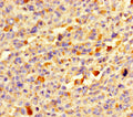 Immunohistochemistry of paraffin-embedded human melanoma using CSB-PA840974LA01HU at dilution of 1:100