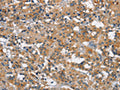 The image on the left is immunohistochemistry of paraffin-embedded Human thyroid cancer tissue using CSB-PA841004(SMAD1 Antibody) at dilution 1/40, on the right is treated with synthetic peptide. (Original magnification: ×200)