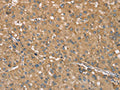 The image on the left is immunohistochemistry of paraffin-embedded Human liver cancer tissue using CSB-PA841017(RNF148 Antibody) at dilution 1/40, on the right is treated with synthetic peptide. (Original magnification: ×200)