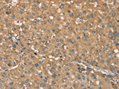 The image on the left is immunohistochemistry of paraffin-embedded Human liver cancer tissue using CSB-PA841017(RNF148 Antibody) at dilution 1/40, on the right is treated with synthetic peptide. (Original magnification: ×200)