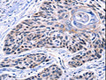 The image on the left is immunohistochemistry of paraffin-embedded Human esophagus cancer tissue using CSB-PA841031(CCNB2 Antibody) at dilution 1/10, on the right is treated with synthetic peptide. (Original magnification: ×200)