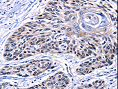 The image on the left is immunohistochemistry of paraffin-embedded Human esophagus cancer tissue using CSB-PA841031(CCNB2 Antibody) at dilution 1/10, on the right is treated with synthetic peptide. (Original magnification: ×200)