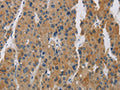 The image is immunohistochemistry of paraffin-embedded Human liver cancer tissue using CSB-PA841149(BCL2L12 Antibody) at dilution 1/20. (Original magnification: ×200)