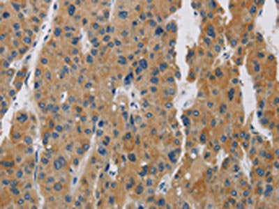The image is immunohistochemistry of paraffin-embedded Human liver cancer tissue using CSB-PA841149(BCL2L12 Antibody) at dilution 1/20. (Original magnification: ×200)