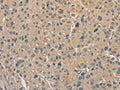 The image on the left is immunohistochemistry of paraffin-embedded Human liver cancer tissue using CSB-PA842443(ALDH8A1 Antibody) at dilution 1/40, on the right is treated with fusion protein. (Original magnification: ×200)