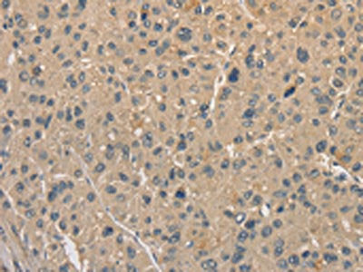 The image on the left is immunohistochemistry of paraffin-embedded Human liver cancer tissue using CSB-PA842443(ALDH8A1 Antibody) at dilution 1/40, on the right is treated with fusion protein. (Original magnification: ×200)