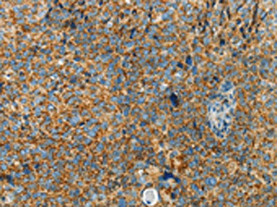 The image on the left is immunohistochemistry of paraffin-embedded Human cervical cancer tissue using CSB-PA842510(BCAT2 Antibody) at dilution 1/70, on the right is treated with fusion protein. (Original magnification: ×200)