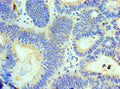 Immunohistochemistry of paraffin-embedded human colon cancer using CSB-PA842644ESR1HU at dilution of 1:100