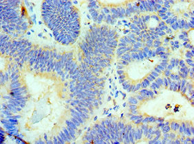 Immunohistochemistry of paraffin-embedded human colon cancer using CSB-PA842644ESR1HU at dilution of 1:100