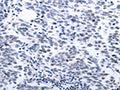 The image on the left is immunohistochemistry of paraffin-embedded Human breast cancer tissue using CSB-PA843257(CCND1 Antibody) at dilution 1/25, on the right is treated with synthetic peptide. (Original magnification: ×200)