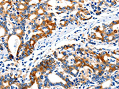 The image on the left is immunohistochemistry of paraffin-embedded Human gastic cancer tissue using CSB-PA843535(ITGAX Antibody) at dilution 1/20, on the right is treated with synthetic peptide. (Original magnification: ×200)