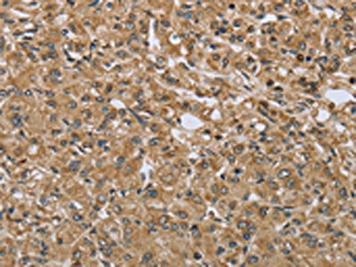 The image on the left is immunohistochemistry of paraffin-embedded Human prostate cancer tissue using CSB-PA843964(TXLNA Antibody) at dilution 1/30, on the right is treated with fusion protein. (Original magnification: ×200)