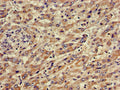 Immunohistochemistry of paraffin-embedded human liver cancer using CSB-PA845163LA01HU at dilution of 1:100