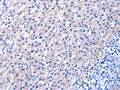 The image on the left is immunohistochemistry of paraffin-embedded Human liver cancer tissue using CSB-PA846755(EGF Antibody) at dilution 1/25, on the right is treated with fusion protein. (Original magnification: ×200)