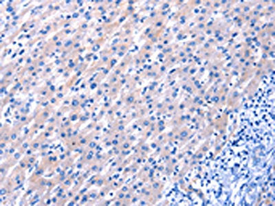 The image on the left is immunohistochemistry of paraffin-embedded Human liver cancer tissue using CSB-PA846755(EGF Antibody) at dilution 1/25, on the right is treated with fusion protein. (Original magnification: ×200)