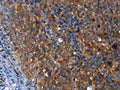 The image on the left is immunohistochemistry of paraffin-embedded Human cervical cancer tissue using CSB-PA846777(MSLN Antibody) at dilution 1/50, on the right is treated with fusion protein. (Original magnification: ×200)