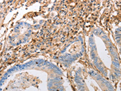 The image on the left is immunohistochemistry of paraffin-embedded Human colon cancer tissue using CSB-PA846842(INA Antibody) at dilution 1/50, on the right is treated with synthetic peptide. (Original magnification: ×200)