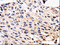 The image is immunohistochemistry of paraffin-embedded Human cervical cancer tissue using CSB-PA847171(ALK Antibody) at dilution 1/25. (Original magnification: ×200)