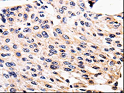 The image is immunohistochemistry of paraffin-embedded Human cervical cancer tissue using CSB-PA847171(ALK Antibody) at dilution 1/25. (Original magnification: ×200)