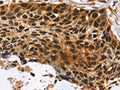 The image on the left is immunohistochemistry of paraffin-embedded Human esophagus cancer tissue using CSB-PA853298(CDX1 Antibody) at dilution 1/20, on the right is treated with fusion protein. (Original magnification: ×200)