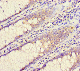 Immunohistochemistry of paraffin-embedded human colon cancer using CSB-PA853396LA01HU at dilution of 1:100