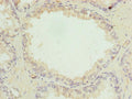 Immunohistochemistry of paraffin-embedded human prostate cancer using CSB-PA853424LA01HU at dilution of 1:100