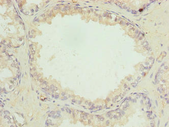 Immunohistochemistry of paraffin-embedded human prostate cancer using CSB-PA853424LA01HU at dilution of 1:100