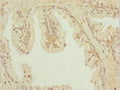 Immunohistochemistry of paraffin-embedded human prostate cancer using CSB-PA854162ESR1HU at dilution of 1:100