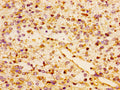 Immunohistochemistry of paraffin-embedded human glioma using CSB-PA856406LA01HU at dilution of 1:100