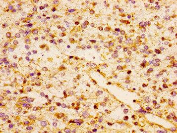 Immunohistochemistry of paraffin-embedded human glioma using CSB-PA856406LA01HU at dilution of 1:100