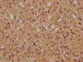 IHC image of CSB-PA856414LA01HU diluted at 1:200 and staining in paraffin-embedded human glioma cancer performed on a Leica BondTM system. After dewaxing and hydration, antigen retrieval was mediated by high pressure in a citrate buffer (pH 6.0). Section was blocked with 10% normal goat serum 30min at RT. Then primary antibody (1% BSA) was incubated at 4°C overnight. The primary is detected by a biotinylated secondary antibody and visualized using an HRP conjugated SP system.