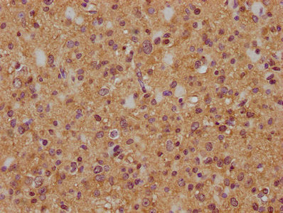 IHC image of CSB-PA856414LA01HU diluted at 1:200 and staining in paraffin-embedded human glioma cancer performed on a Leica BondTM system. After dewaxing and hydration, antigen retrieval was mediated by high pressure in a citrate buffer (pH 6.0). Section was blocked with 10% normal goat serum 30min at RT. Then primary antibody (1% BSA) was incubated at 4°C overnight. The primary is detected by a biotinylated secondary antibody and visualized using an HRP conjugated SP system.
