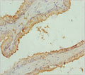 Immunohistochemistry of paraffin-embedded human prostate cancer using CSB-PA856886ESR2HU at dilution of 1:100