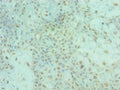 Immunohistochemistry of paraffin-embedded human breast cancer using CSB-PA857009ESR2HU at dilution of 1:100