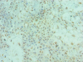 Immunohistochemistry of paraffin-embedded human breast cancer using CSB-PA857009ESR2HU at dilution of 1:100