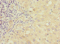 Immunohistochemistry of paraffin-embedded human liver cancer using CSB-PA857450ESR2HU at dilution of 1:100