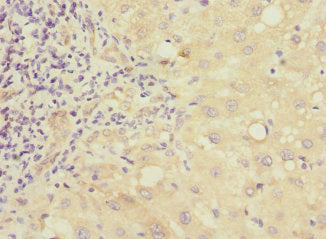Immunohistochemistry of paraffin-embedded human liver cancer using CSB-PA857450ESR2HU at dilution of 1:100