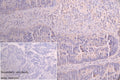 IHC image of CSB-PA857882LA01HU diluted at 1:250 and staining in paraffin-embedded human colorectal cancer performed on a Leica BondTM system. After dewaxing and hydration, antigen retrieval was mediated by high pressure in a citrate buffer (pH 6.0). Section was blocked with 10% normal goat serum 30min at RT. Then primary antibody (1% BSA) was incubated at 4°C overnight. The primary is detected by a Goat anti-rabbit polymer IgG labeled by HRP and visualized using 0.05% DAB.