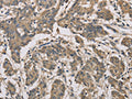 The image is immunohistochemistry of paraffin-embedded Human colon cancer tissue using CSB-PA858095(CYCS Antibody) at dilution 1/70. (Original magnification: ×200)
