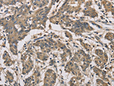 The image is immunohistochemistry of paraffin-embedded Human colon cancer tissue using CSB-PA858095(CYCS Antibody) at dilution 1/70. (Original magnification: ×200)