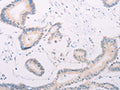 The image on the left is immunohistochemistry of paraffin-embedded Human colon cancer tissue using CSB-PA858409(MAP3K12 Antibody) at dilution 1/30, on the right is treated with fusion protein. (Original magnification: ×200)