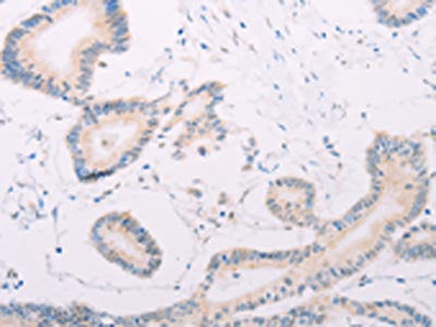 The image on the left is immunohistochemistry of paraffin-embedded Human colon cancer tissue using CSB-PA858409(MAP3K12 Antibody) at dilution 1/30, on the right is treated with fusion protein. (Original magnification: ×200)