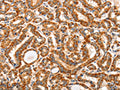 The image on the left is immunohistochemistry of paraffin-embedded Human thyroid cancer tissue using CSB-PA858560(AIM2 Antibody) at dilution 1/60, on the right is treated with fusion protein. (Original magnification: ×200)