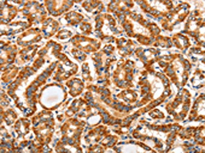 The image on the left is immunohistochemistry of paraffin-embedded Human thyroid cancer tissue using CSB-PA858560(AIM2 Antibody) at dilution 1/60, on the right is treated with fusion protein. (Original magnification: ×200)