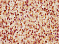 IHC image of CSB-PA858733LA01HU diluted at 1:300 and staining in paraffin-embedded human glioma performed on a Leica BondTM system. After dewaxing and hydration, antigen retrieval was mediated by high pressure in a citrate buffer (pH 6.0). Section was blocked with 10% normal goat serum 30min at RT. Then primary antibody (1% BSA) was incubated at 4&deg;C overnight. The primary is detected by a biotinylated secondary antibody and visualized using an HRP conjugated SP system.